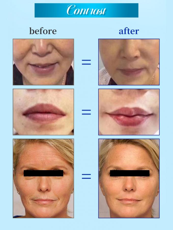 Fast delivery buttock enlargement collagen face injection hyaluronic