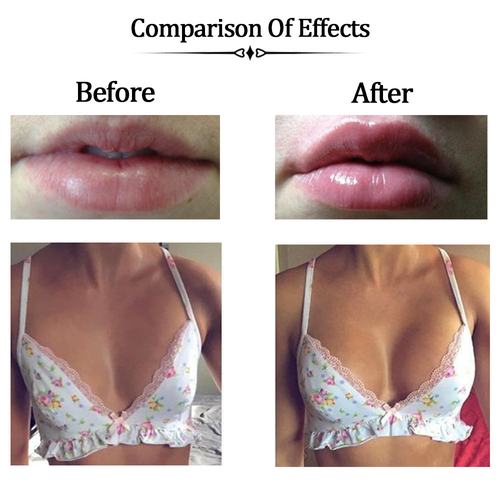 Auro Secret Cross Linked Filler Hyaluronic Acid Injectable