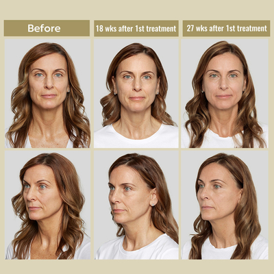 safe fast dissolving dermal filler angelfill poly lactic acid plla filler