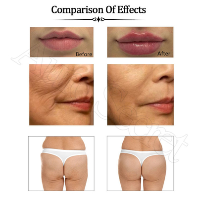 Best effect acido hialuronico reticulado cross linked hyaluronic acid lip injections dermal filler