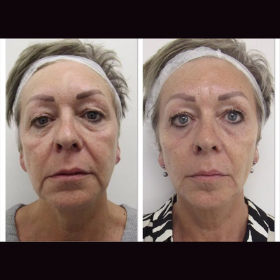 Safe Skin Tightening Cog Barbed Thread Lifting Reborn Pdo Thread Blunt mono